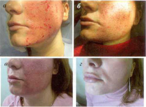 stages of skin regeneration after fractional ablation procedure