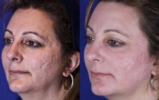 partial laser rejuvenation before and after photos