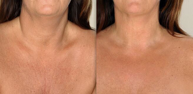 Decollete zone before and after rejuvenating procedures