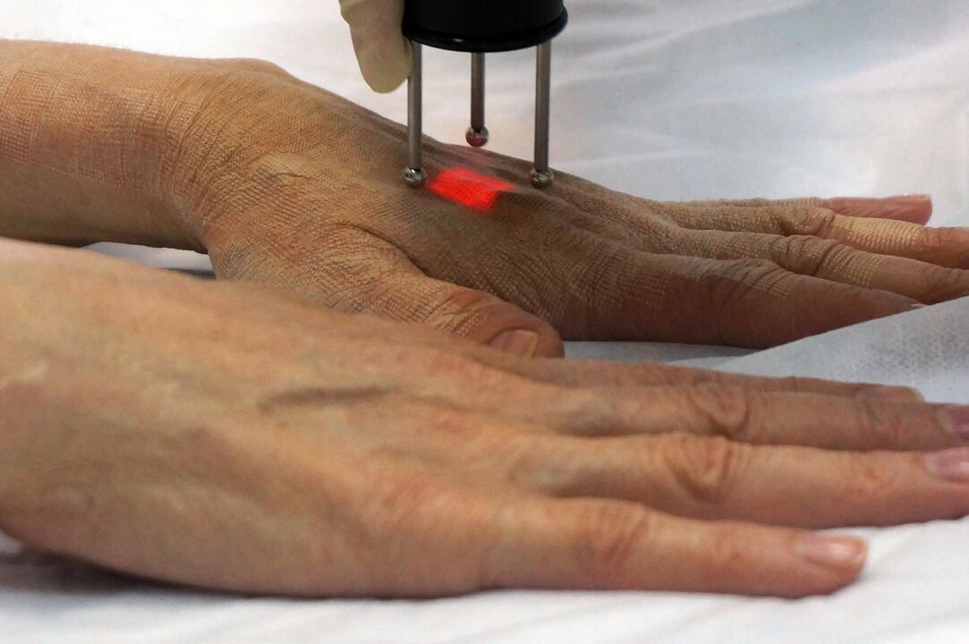 Laser hand rejuvenation by non-ablation method