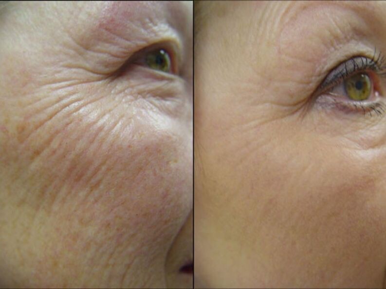 Before and after laser rejuvenation procedures - significant reduction of wrinkles