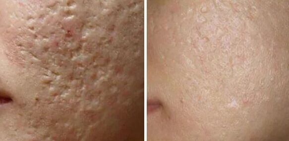 Laser scar sanding