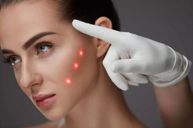 Laser skin rejuvenation