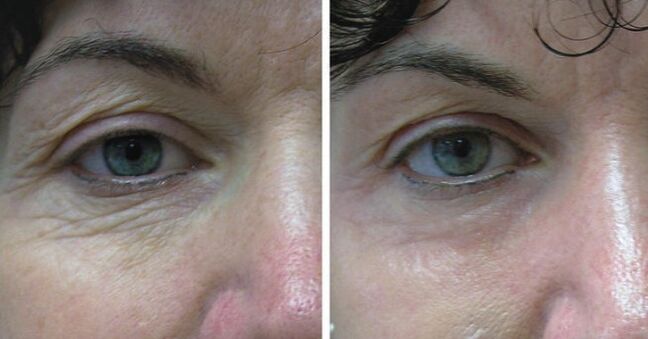 A leather laser around the eyes