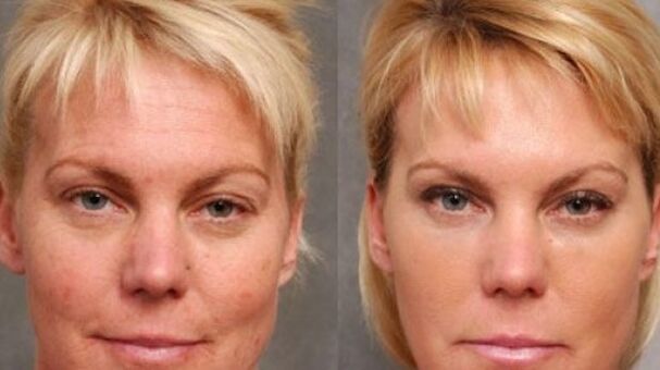 Before and after rejuvenation procedure