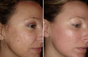 facial skin laser restoration before and after photos